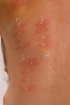 After antigens are applied to a patient's back, her skin reacts with bumps and/or wheals — and possibly itchiness. Once the test is complete, in 15 minutes, the provider wipes away the antigens are the reaction(s) fade away.